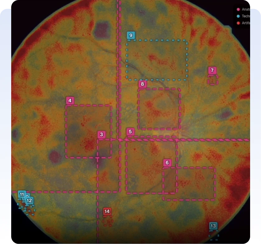 Qlens New Color-coded retinal scan with numbered areas marked for image analysis.
