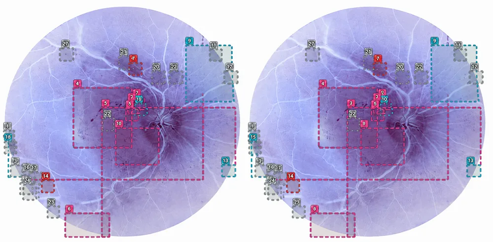 Side-by-side retinal images with numbered markers and color-coded analysis regions.